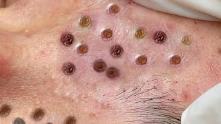 Big Cystic Acne Blackheads Extraction Whiteheads \u0026 Milia, Whiteheads Removal, Pimples Popping #19