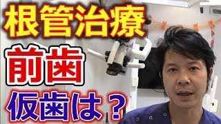 前歯を根管治療する時の仮歯はどうなるのか？【千葉市中央区の歯医者】