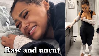 We documented Ally’s Brazilian Butt Lift recovery for 2 Weeks straight... | THE RAW UNCUT TRUTH!!!