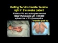 What is Wide Awake Hand Surgery?