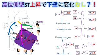 心電図：暗記からの卒業 64話 　超広範囲前壁梗塞