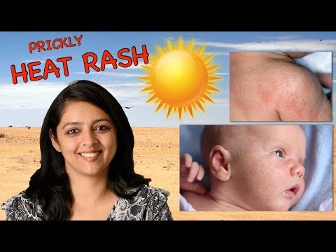 How To Prevent & Treat Prickly Heat Rashes In Babies || Home Remedies How To Prevent & Treat Prickly Heat Rashes In Babies || Home Remedies