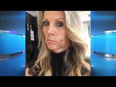Surgery to Get Dimples?! Surgery to Get Dimples?!