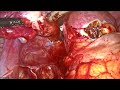 endometriosis live surgery june 2023