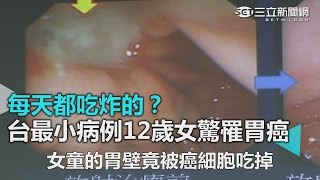 每天都吃炸的？ 台最小病例12歲女驚罹胃癌｜三立新聞網SETN.com