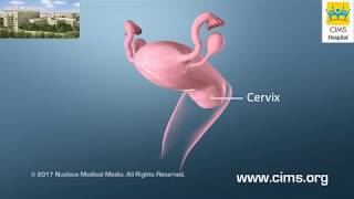 Pap and HPV Testing  (Gujarati) - CIMS Hospital