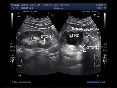 Ultrasound Video showing renal Angiomyolipoma with stones at P.U.J. Ultrasound Video showing renal Angiomyolipoma with stones at P.U.J.