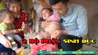 Kỳ Lạ Cháu Bé Có 2 Bộ Phận SINH D.Ụ.C Cả Nam Và Nữ... Ở HÀ GIANG