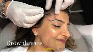 PDO-THREAD LIFT PROCEDURE BY MEDiTHREAD - Eyebrow Lift