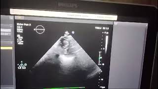 Part 2 : Bedside clinical imageology in 64F with PUO 2 years