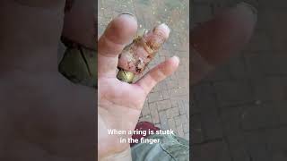 what happens when a ring is stuck in the finger