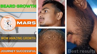 BEARD GROWTH || Amazing beard growth results || Beard journey finally successful ✅️ From minoxidil