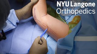 Optimizing Transhumeral Amputations