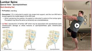 Stork Standing Test (for Spondylolisthesis) | Rationale \u0026 Interpretation