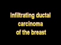 What Is The Definition Of Infiltrating ductal carcinoma of the breast