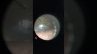 Small Ruptured Tympanic Membrane, Right (perforated ear drum)