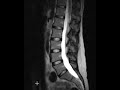 Lumbar spine disc herniations