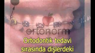 Ortodontik Tedavide Oluşabilecek TME Ağrıları (Ortodontik Tedavide İlk Günler)