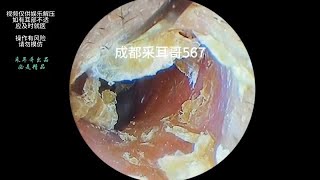 采耳哥-Carefully clean the thick and dry sections of the external auditory canal ｜567