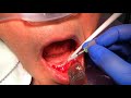 freehand overdenture surgery how to lineup your angles without a guide