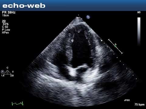 The Echoweb Patient Diagnosed With Lv Diastolic Dysfunction And