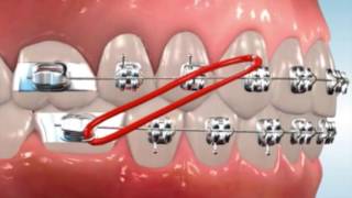 Class 2 Elastics - Easton Ortho 101 with Dr. Loftus