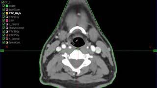 Larynx - GTV/CTV