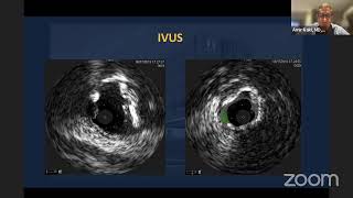 Bifurcation PCI in AMI Cardiogenic Shock