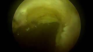 HYSTEROSCOPIC CORRECTION OF  ISTHMOCELE