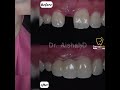 Dental Bridge / Jambatan Gigi