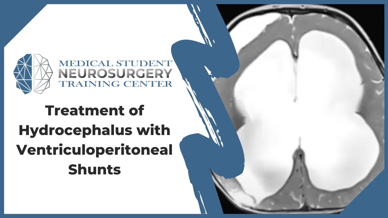 Treatment Of Hydrocephalus With Ventriculoperitoneal Shunts - YouTube