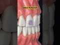 braces preparation