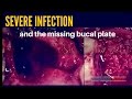 Severe infection and the missing buccal plate