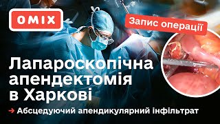 УДАЛЕНИЕ АППЕНДИЦИТА в ХАРЬКОВЕ — Запись лапароскопической операции