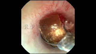 Kidney Stone Removal with RIRS Technology