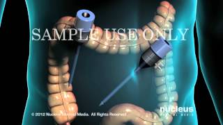 Laparoscopic appendectomy