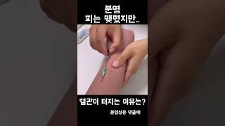 IV 정맥주사 혈관 터지는 이유는?