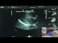 ultrasound of the right liver lobe