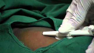 Contraceptive Implants - 11 - Procedure: Insert implant