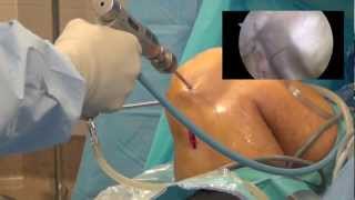 Arthroscopic ACL Reconstruction (Detailed)