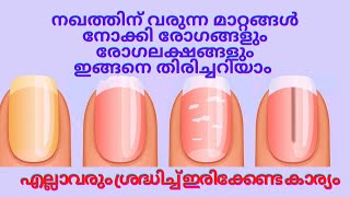 നഖത്തിനു ഉണ്ടാകുന്ന മാറ്റങ്ങളിലൂടെ നമ്മുടെ നമ്മുടെ ശരീരത്തിൽ ഉണ്ടാകുന്ന അസുഖങ്ങൾ ഇങ്ങനെ തിരിച്ചറിയാം