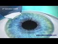 Third Generation Laser Vision Correction at Vision Mendez