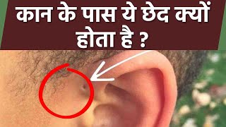 कान के ऊपर छेद होना Preauricular Pit, Preauricular Ear Hole क्या है | Boldsky *Health