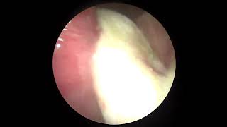 부비동내 농포 제거 ( removal of pyocele in the sinus cavity)