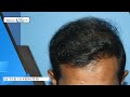 hair transplant india best hair transplant results delhi pune mumbai jaipur dr. seema garg