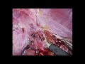 CASE SERIES OF THE INTER LAENNEC APPROACH FOR LAPAROSCOPIC ANATOMICAL S7 SEGMENTECTOMY IN SEMI PRONE