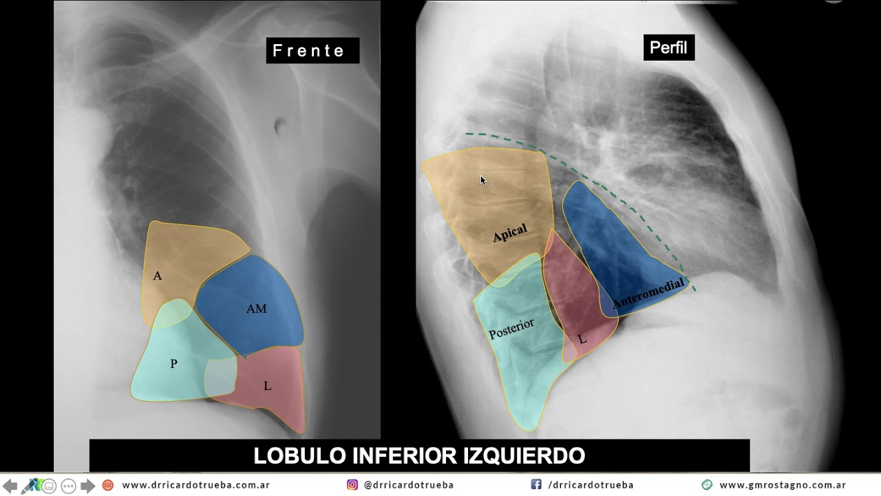 RADIOLOGIA NORMAL DEL TORAX EN 15 MINUTOS - YouTube