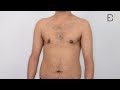 gynaecomastia removal male breast gland patient 3170 before u0026 after