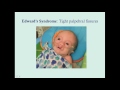 patau s and edward s syndrome crash medical review series