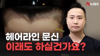 헤어라인 문신 하고도 모발이식 다시 합니다... ㅣ 문신 실패 사례